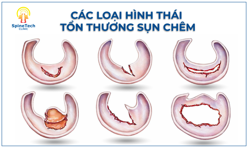 PHÂN LOẠI HÌNH THÁI RÁCH SỤN CHÊM - Spinetech.com.vn