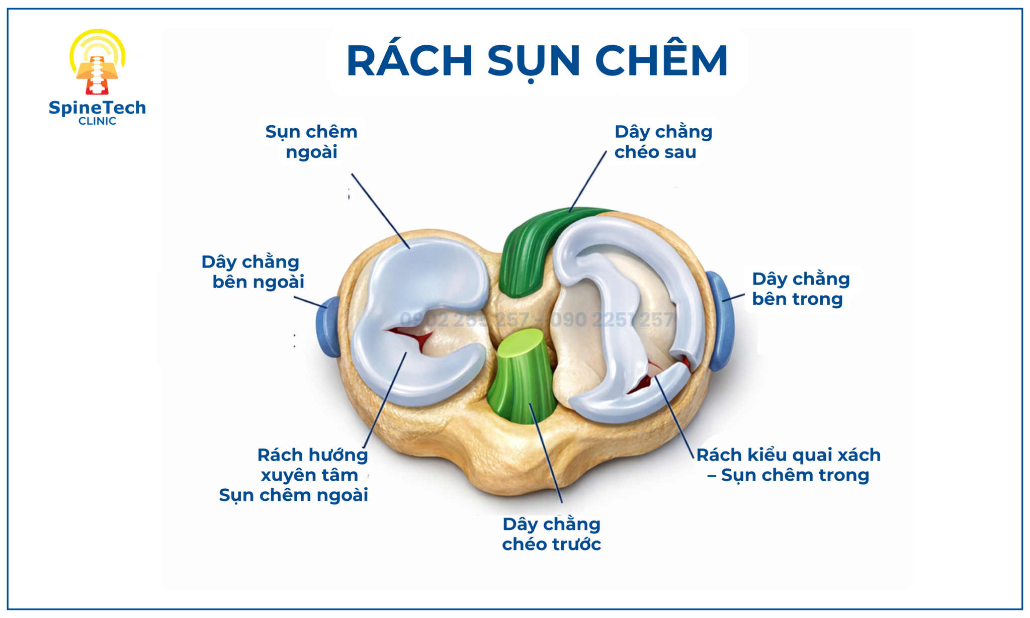 PHÂN LOẠI HÌNH THÁI RÁCH SỤN CHÊM - Spinetech.com.vn